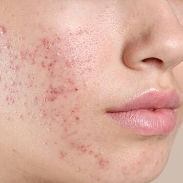 acne common skin issue