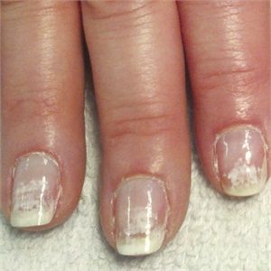 understanding nail damage to repair nails