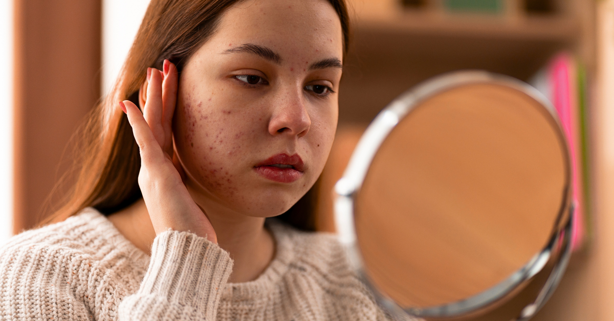 5 Biggest Skincare Mistakes That Are Causing You Acne