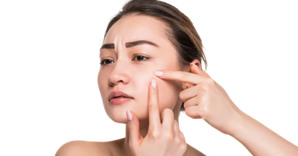 8 Effective Natural Ingredients for Treating Acne