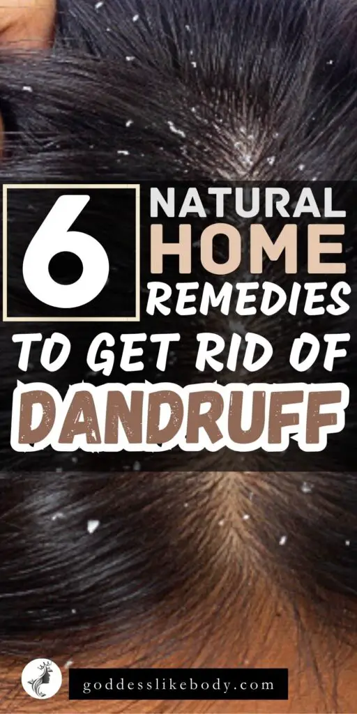 6 Natural Home Remedies to Get Rid of Dandruff