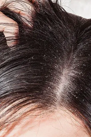 Scalp Health